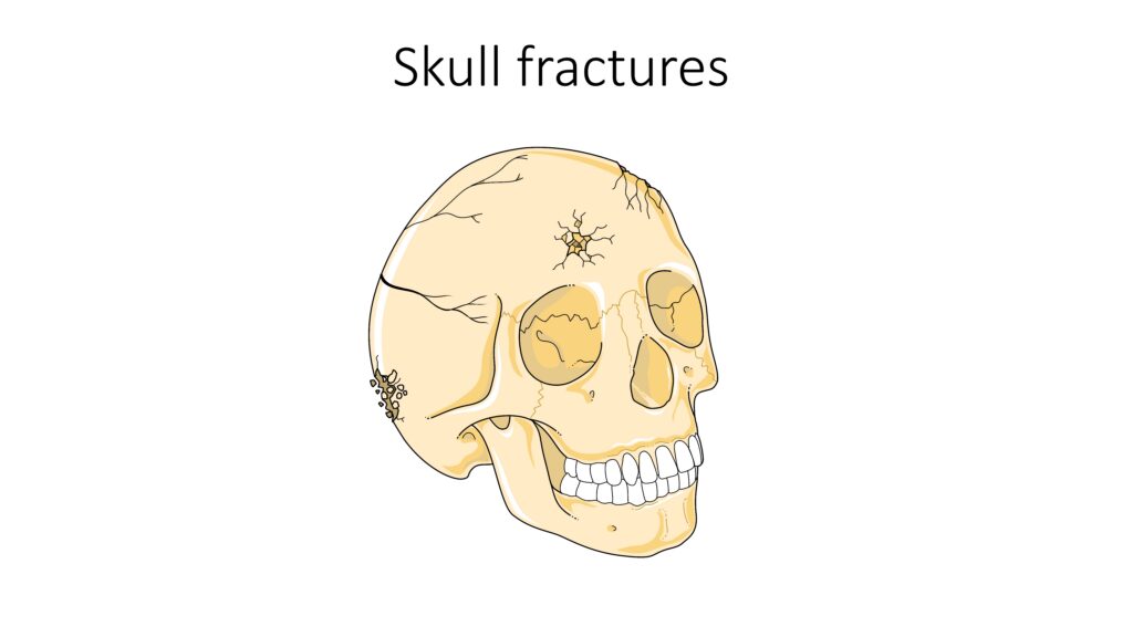 Illustration of a skull showing fracture lines