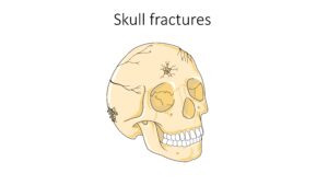Illustration of a skull showing fracture lines