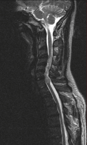 MRI of the neck showing an ependymoma, a tumor growing inside the spinal cord
