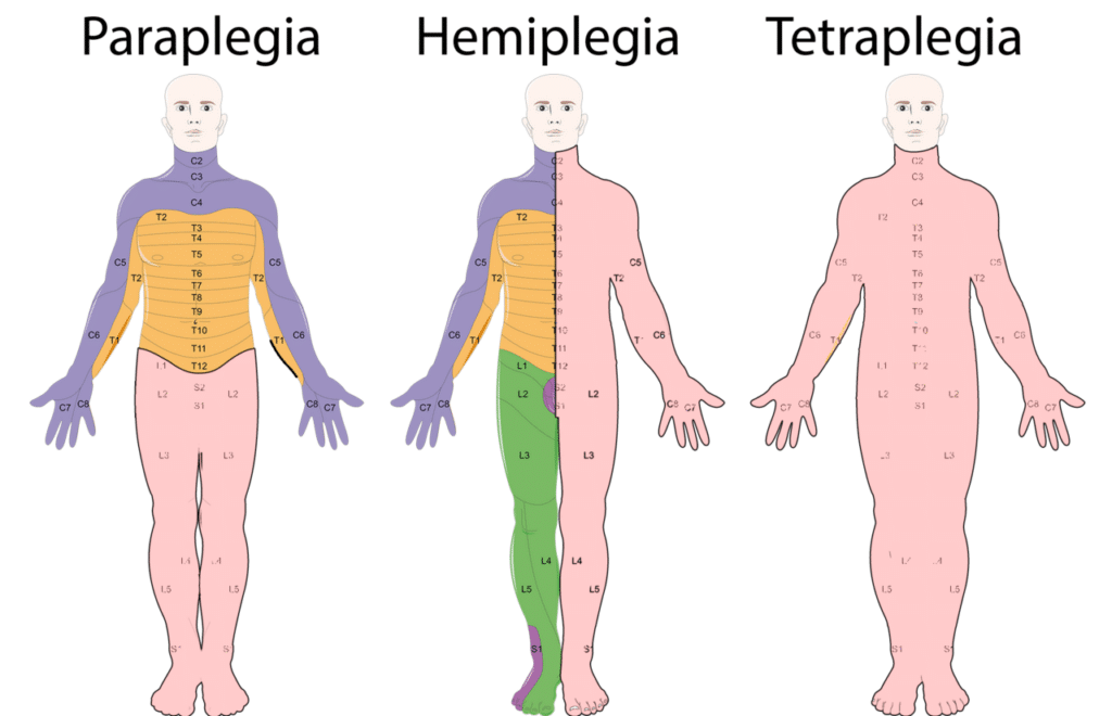 Diagram of how the level of a spinal cord injury affects the body