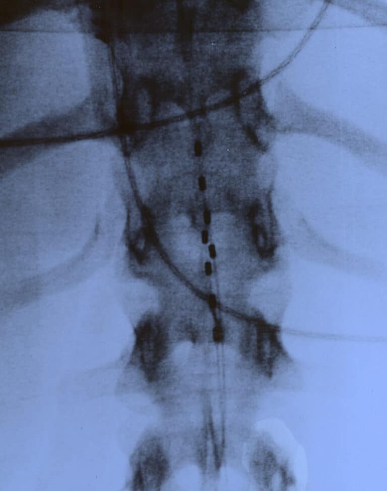 Spinal cord stimulator system
