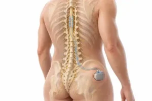 Illustration of a spinal cord stimulator, with two leads along the spinal cord connected to a small battery implanted under the skin of the lower back