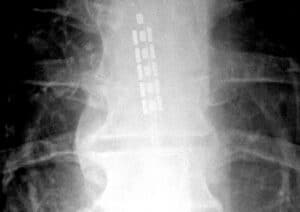 X-ray showing spinal cord stimulator leads placed along the spine