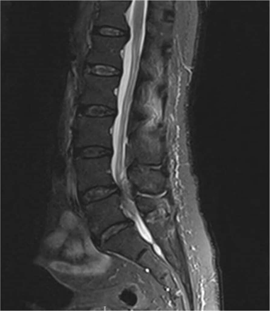 MRI of the lower spine showing an epidural abscess pressing on the nerves
