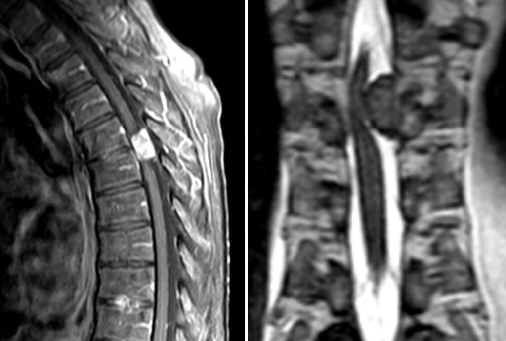 MRI of the thoracic spine showing a meningioma inside the spinal canal pressing on the spinal cord