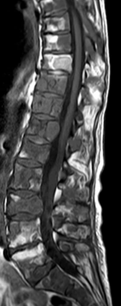 MRI of the spine showing cancer that has spread to several vertebrae