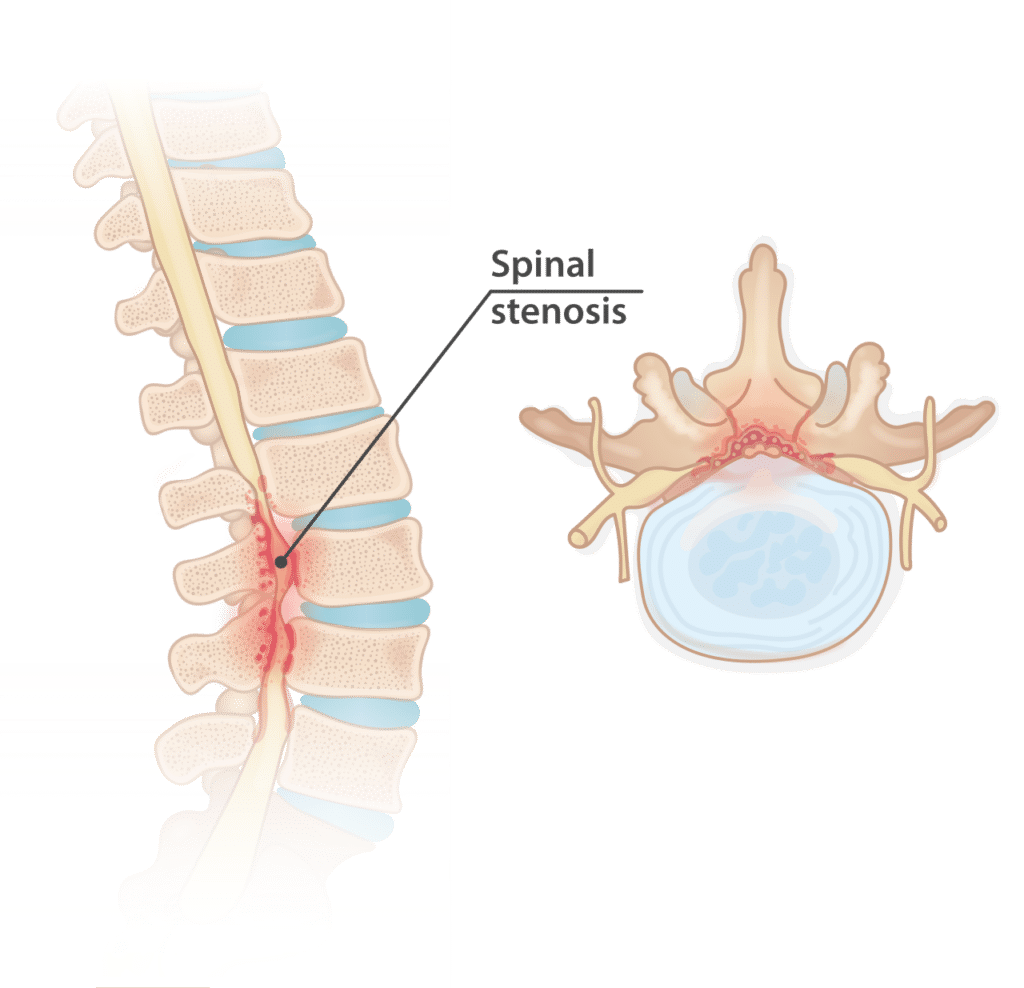 Spinal stenosis seen from the side and from above