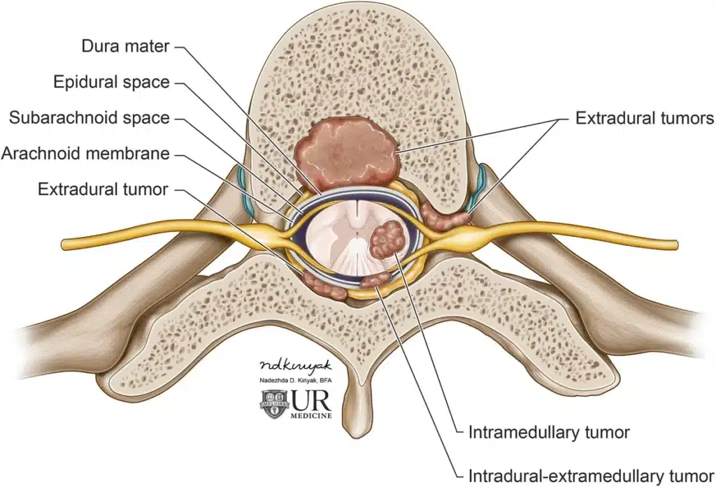 Illustration of a cross-section of the spine showing where extradural, intradural-extramedullary and intramedullary tumors grow