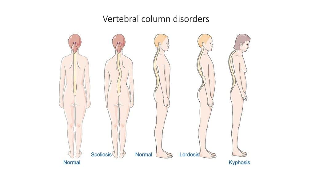 Comparison of a normal spine with scoliosis, lordosis and kyphosis