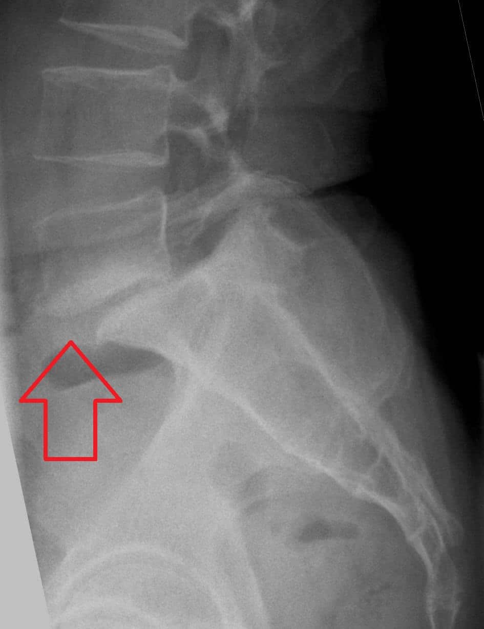 Side-view X-ray showing spondylolisthesis at L5-S1