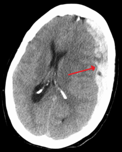 CT scan of the head with a red arrow pointing to a subdural hematoma pressing on the brain