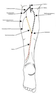 Diagram of the lower leg showing the path of the sural nerve down the calf to the outside of the ankle