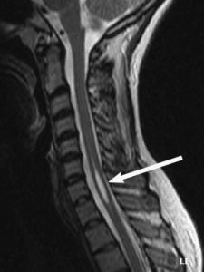 MRI of the neck with an arrow pointing to a syrinx, a fluid-filled cavity inside the spinal cord