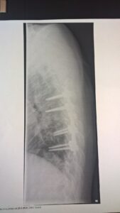 Side-view X-ray of a thoracic spinal fusion with screws and rods