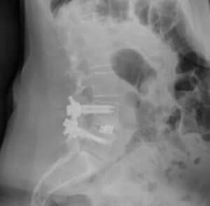 Side-view X-ray of a TLIF with screws, rods and an interbody spacer