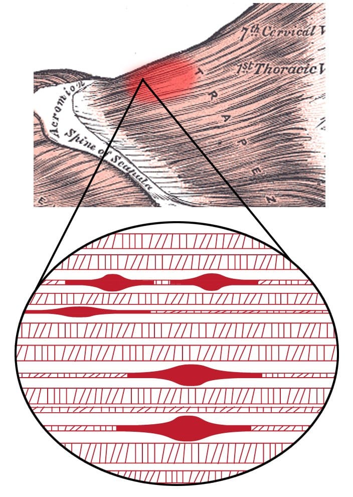 Illustration of a trigger point knot in a muscle