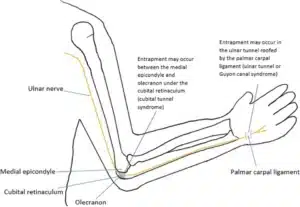 Diagram of the ulnar nerve in the arm showing where it can be trapped at the elbow and wrist