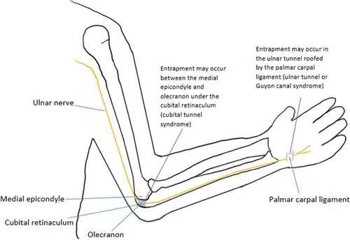 Illustration of the ulnar nerve showing the two most common places it gets compressed: the elbow (cubital tunnel) and the wrist (Guyon canal)