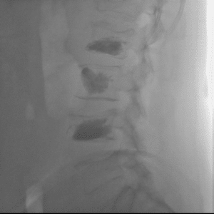 Side-view X-ray after vertebroplasty showing bone cement in two fractured vertebrae